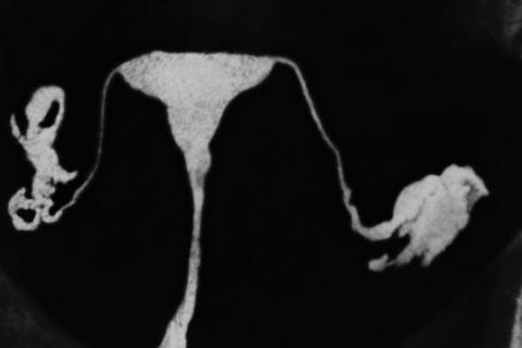 fallopian tubes